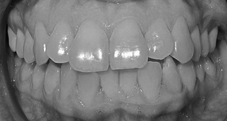 Caso tratamiento en Adulto ortodoncia
