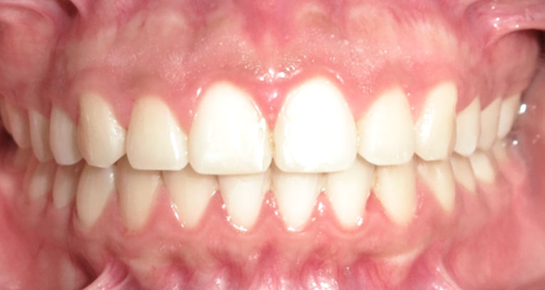 Caso leve apiñamiento ortodoncia